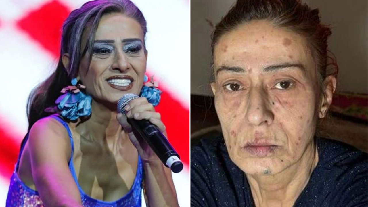 Yıldız Tilbe, yüzündeki yanıklarla ilgili son durumu açıkladı! 6 504913